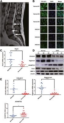PLK1 Mitigates Intervertebral Disc Degeneration by Delaying Senescence of Nucleus Pulposus Cells